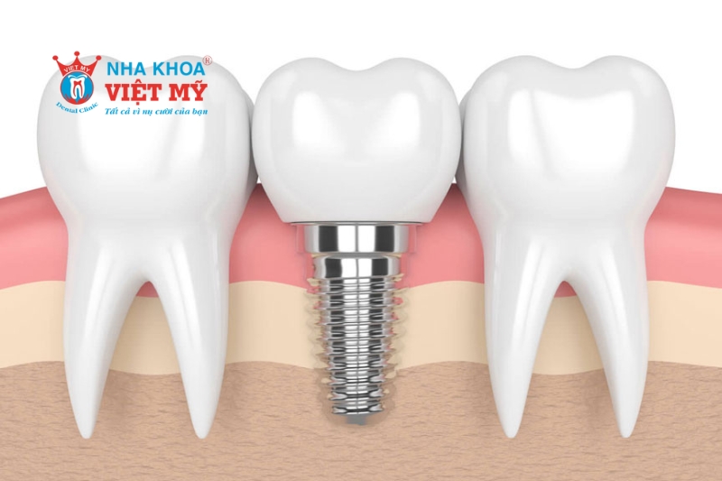 Tuổi thọ của răng Implant có thể là trọn đời