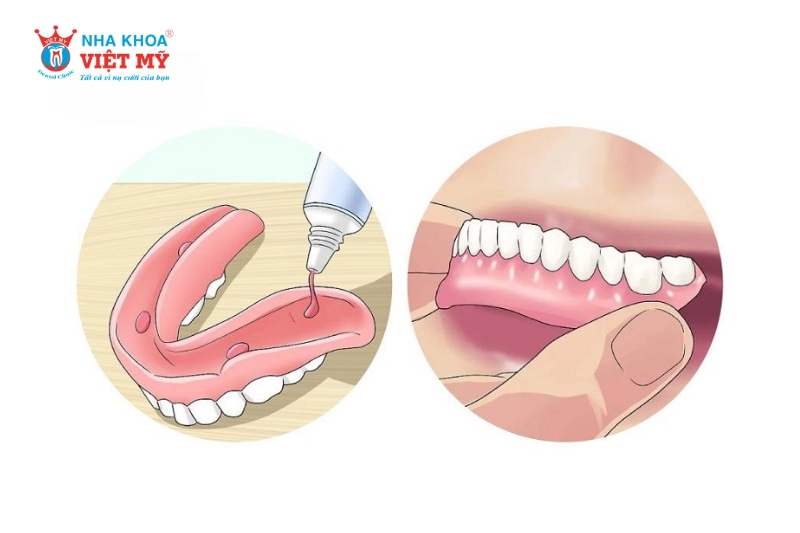 Cách s?dụng keo dán hàm gi?Fixodent ngay tại nhà