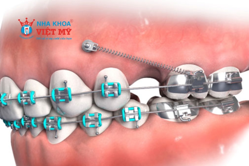 Minivis có kích thước nhở làm bằng Titan cấy vào xương hàm khi niềng răng