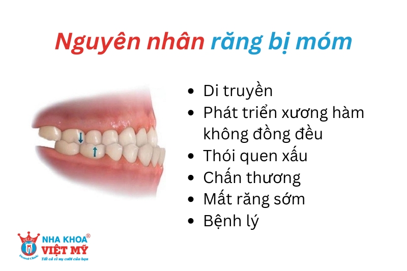 nguyên nhân răng bị móm