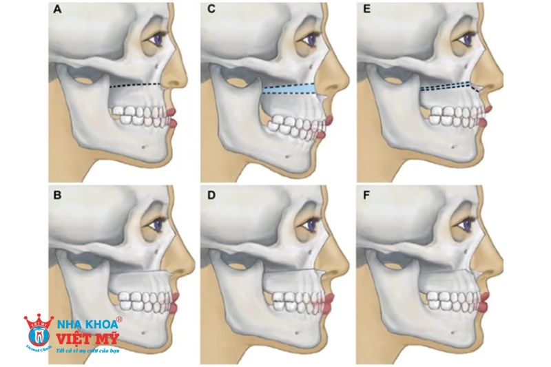 phương pháp phẫu thuật hàm cho răng bị móm