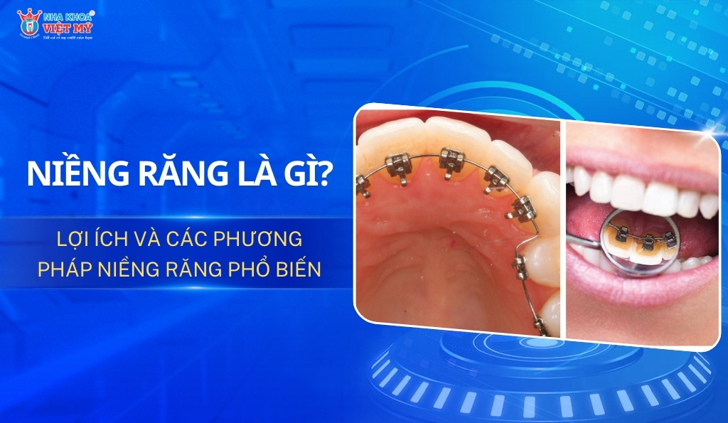 thumbnail niềng răng là gì