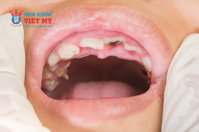 Mất răng sớm dẫn đến khớp cắn sâu - overbite