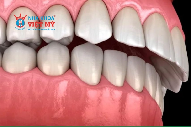 Overbite hay còn gọi là khớp cắn sâu