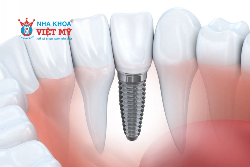 răng giả bị lung lay do kỹ thuật implant không đạt chuẩn