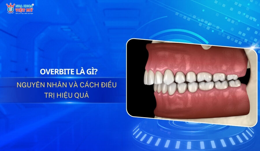 thumbnail overbite là gì